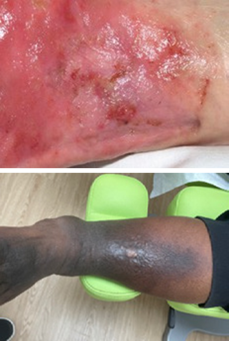 Erythema