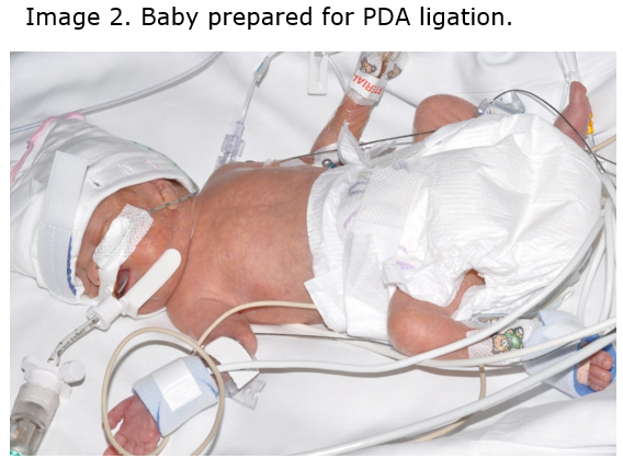 Image 2. Baby prepared for PDA ligation