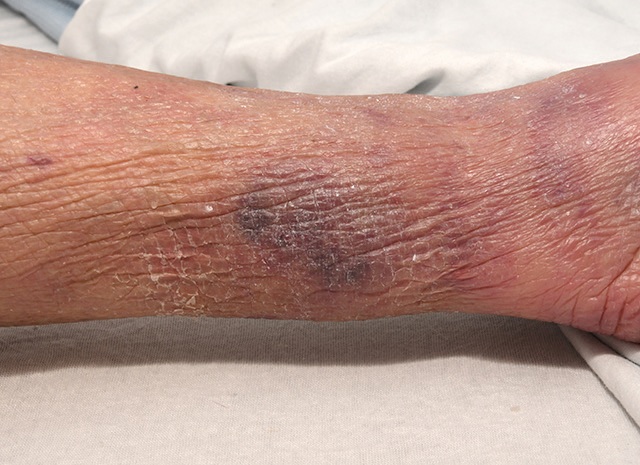 Non bleeding haematoma