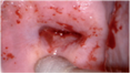 Atrophic Cervix