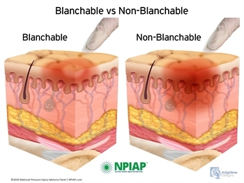 Blanchable and non-blanchable