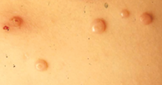 Flesh coloured or pink papules with umbilicated centre image