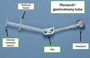 Image of a Monarch gastrostomy tube for enteral feeding