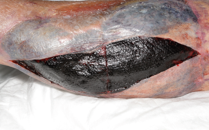 Open non bleeding haematoma