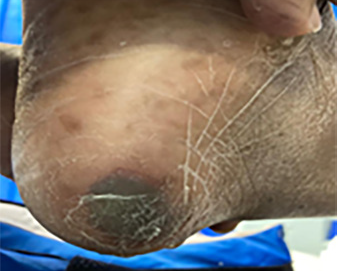 Suspected deep tissue injury