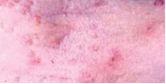 Resolving molluscum contagiosum image