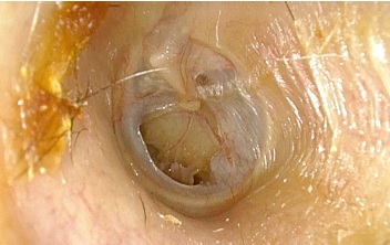 image of TM perforation
