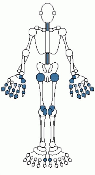 Diagram of typical joints affected in osteoaethritis