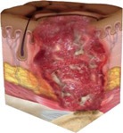 Full thickness tissue loss