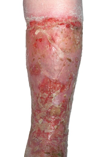 Acute cellulitis broken skin