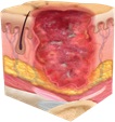 Full thickness skin loss